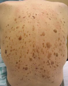 804px-Seborrheic_keratosis_on_human_back-768x978