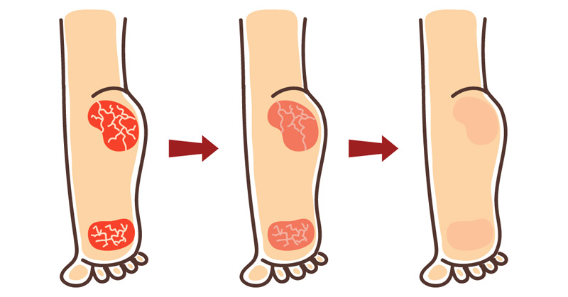 How To Cure Cracked Feet or Heel Quickly