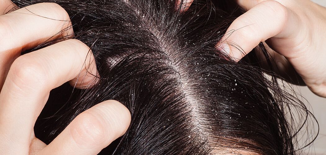 Dandruff – Symptoms and Causes