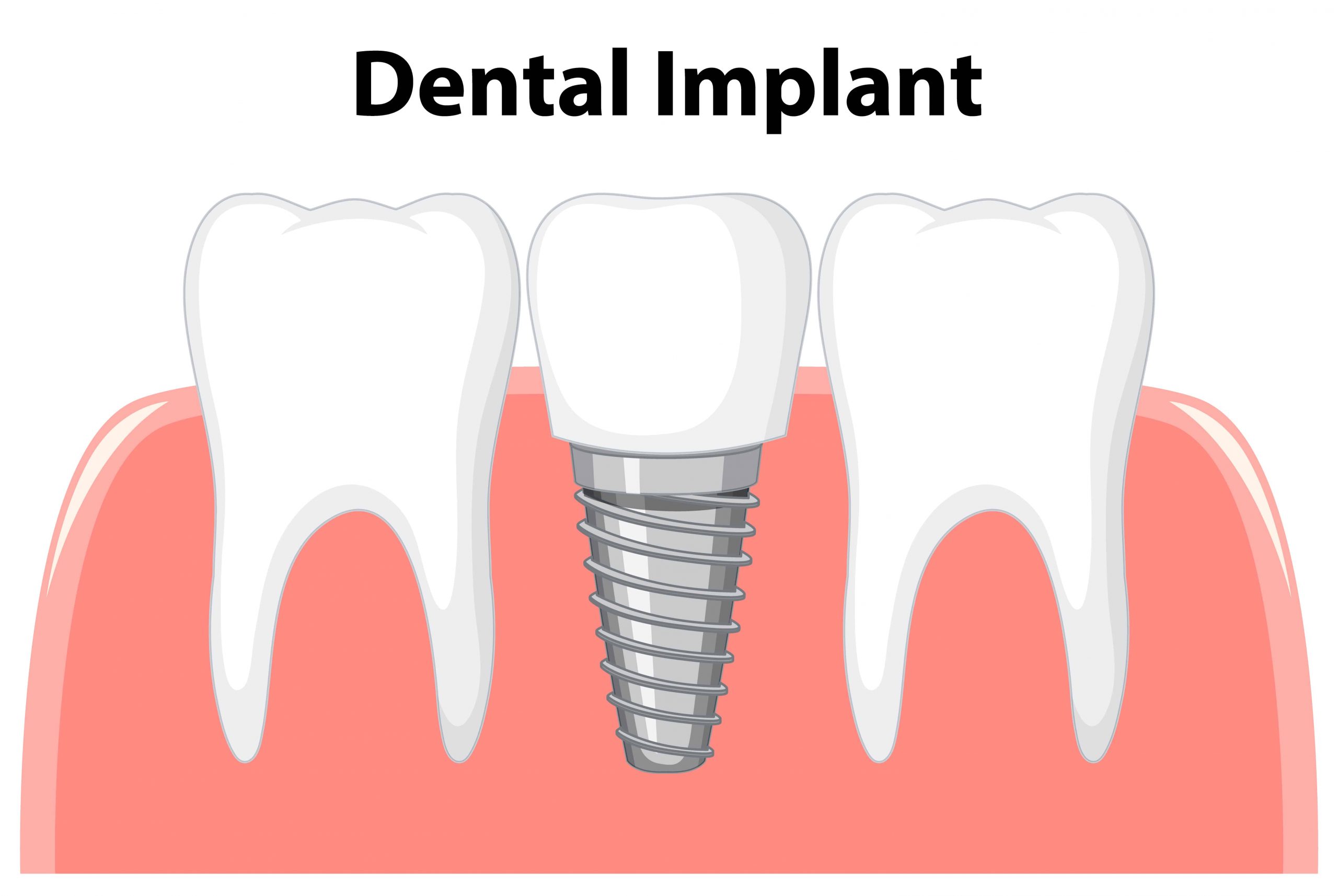 Dental-care