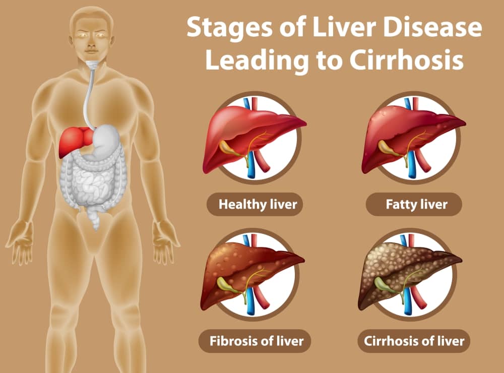 Liver Cirrhosis – Symptoms, Causes, Ayurvedic Treatment