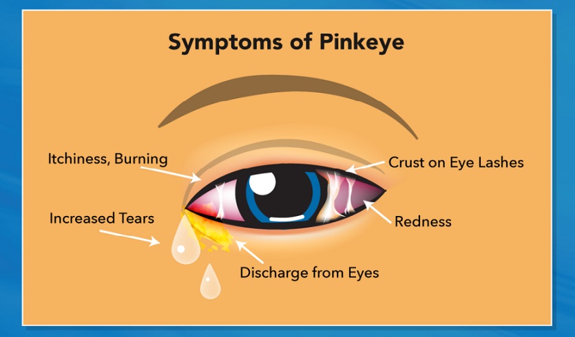 Ten Best Home Remedies For Pink Eye (Conjunctivitis)