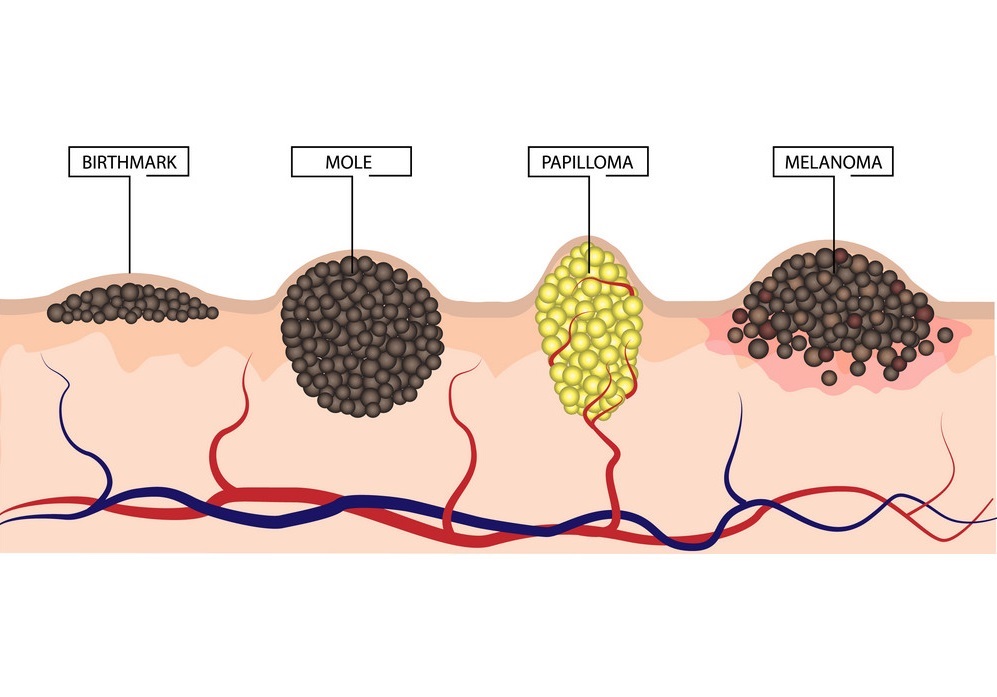 Early Signs Of Skin Cancer