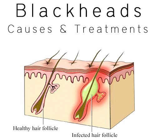 Tips To Remove Blackheads